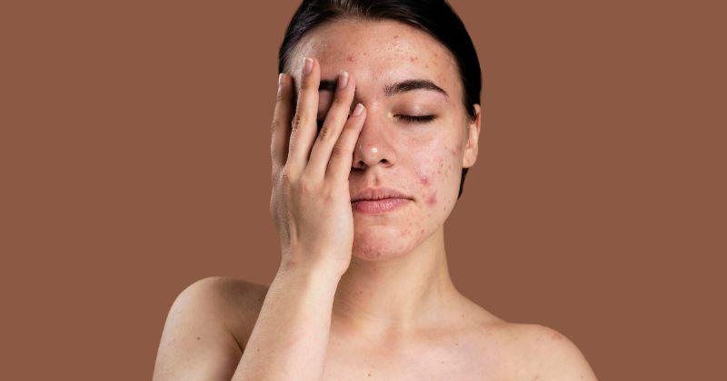 Viêm Nang Lông Là Gì? Nguyên Nhân Bị Viêm Nang Lông